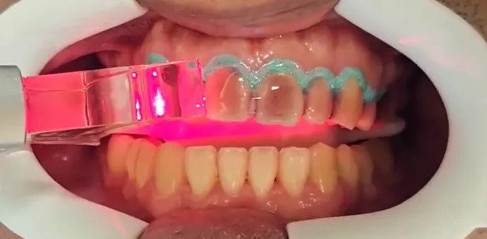Blanqueamiento con láser: la punta del láser activa el gel sobre los dientes superiores