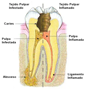 Diente con pulpa infectada y pulpa inflamada: caries, absceso y ligamento inflamado