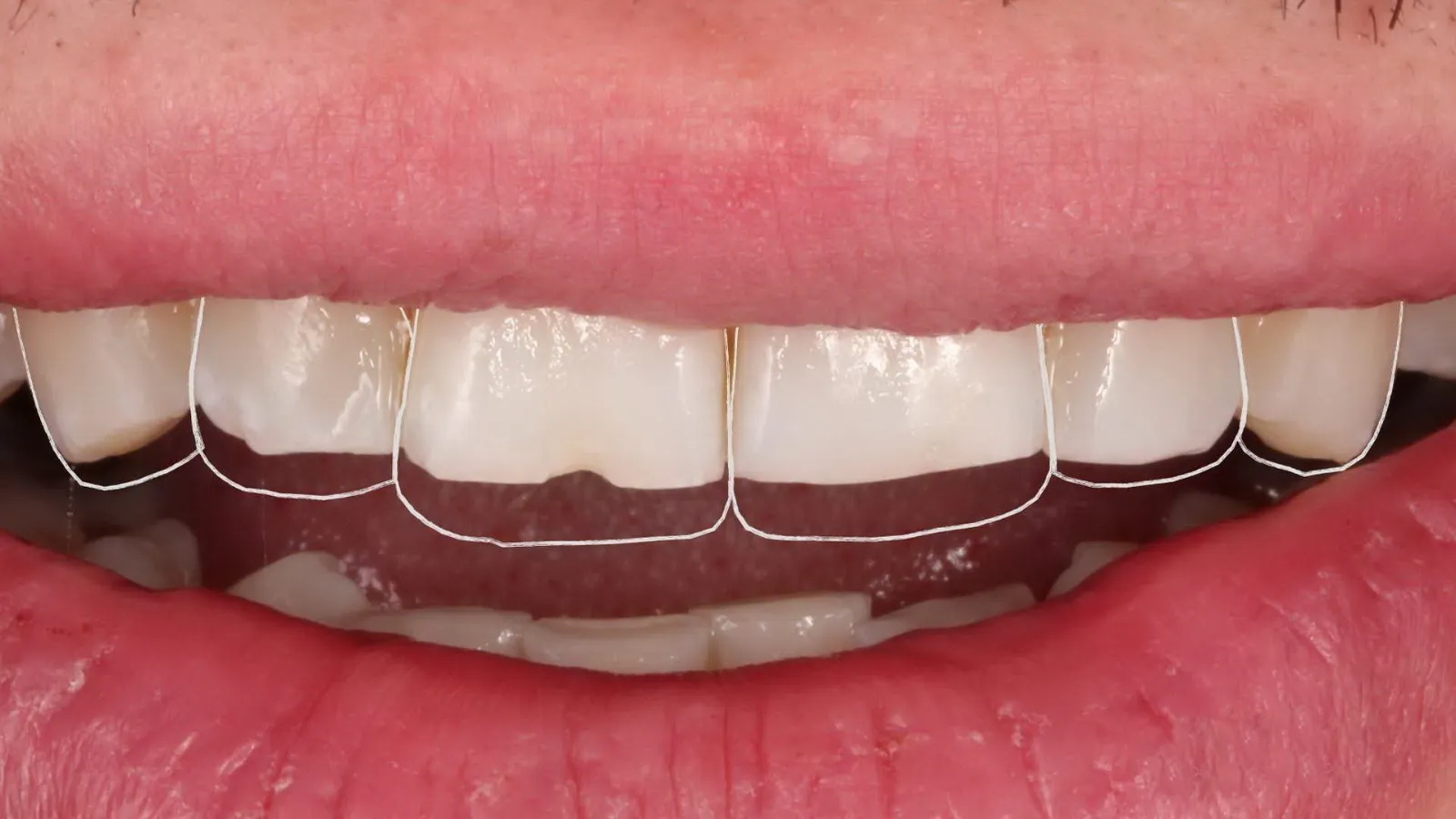 Diseño digital de sonrisa: el contorno de los dientes planificados, dibujado sobre la sonrisa del paciente