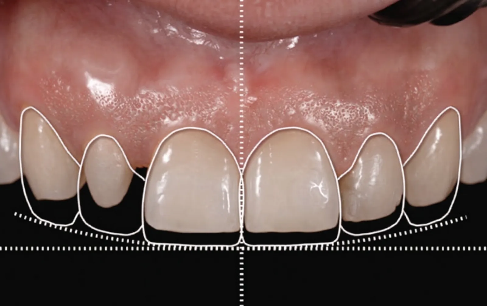 Diseño digital de sonrisa: contorno planificado de los seis dientes anteriores, con la línea media y la curva de los bordes como referencia