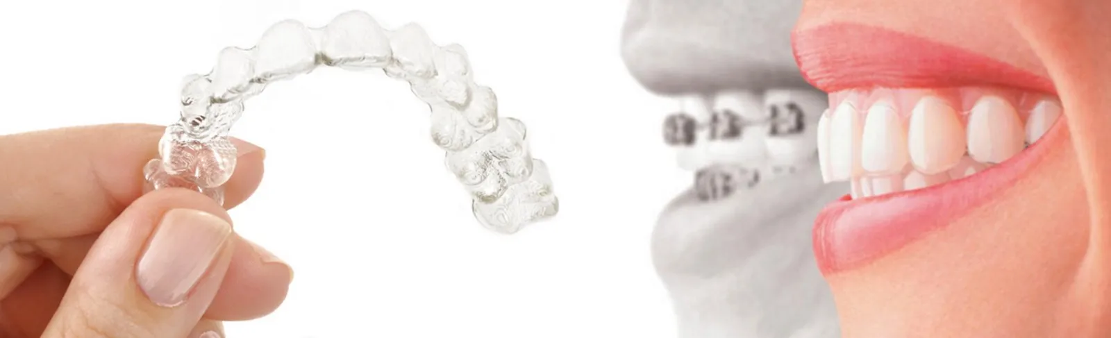 Un alineador transparente en la mano, junto a una sonrisa con brackets y otra con el alineador puesto