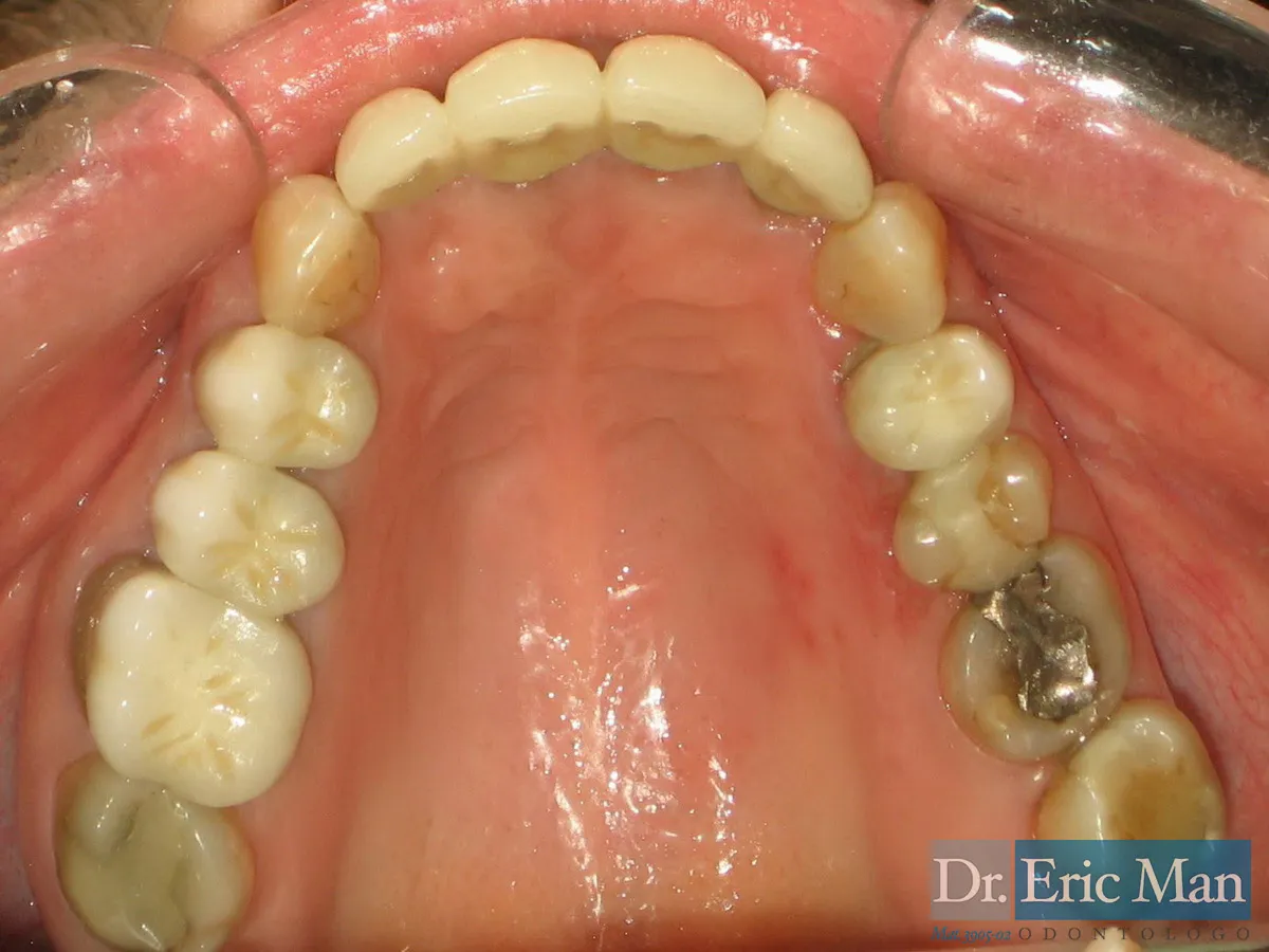 Rehabilitación C, comparación 7: antes