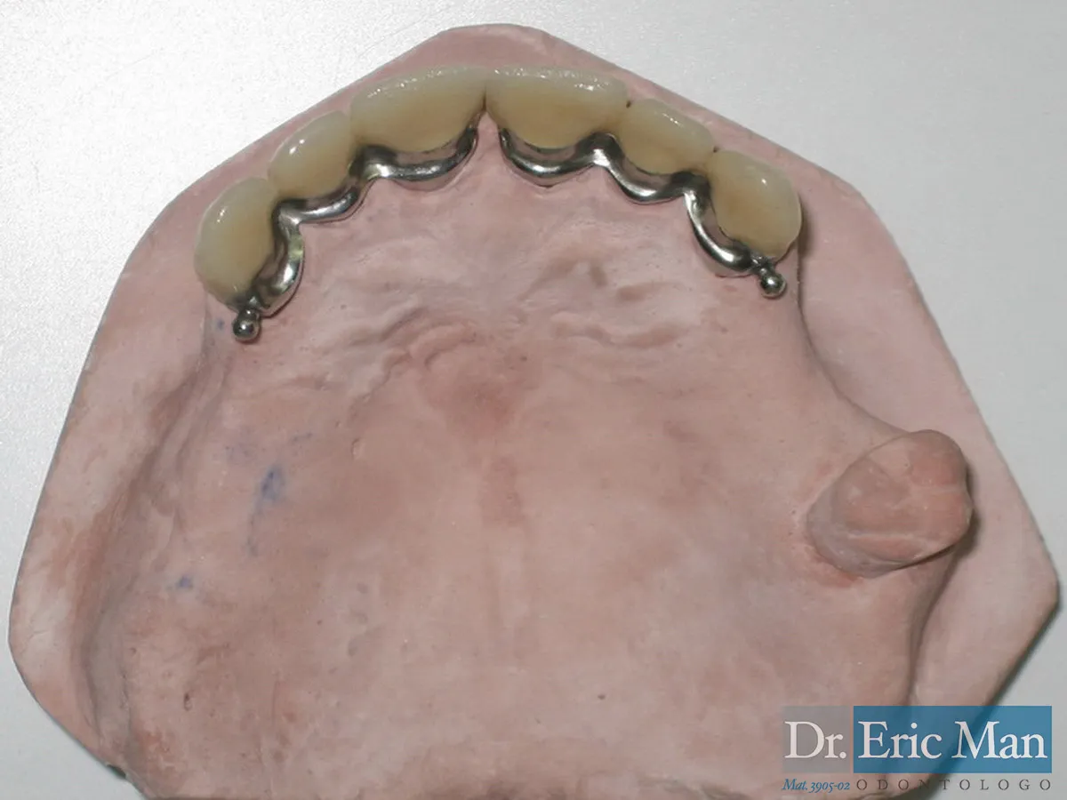 Rehabilitación D, foto adicional 2: prótesis
